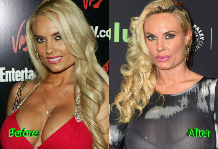 Coco Austin Cosmetic Procedure Before and After