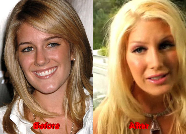 Heidi Montag Plastic Surgery before after cheeks chin nose