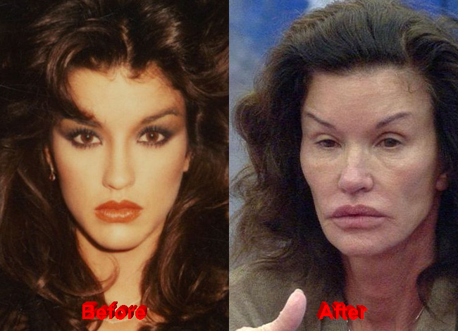 Janice Dickinson Plastic Surgery before after facelift