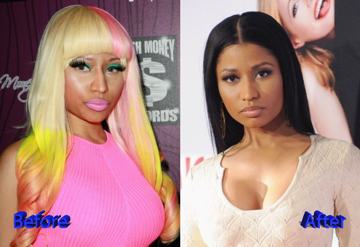 Nicki Minaj Before and After Cosmetic Surgery