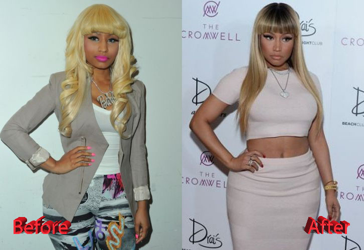 Nicki Minaj Plastic Surgery Before and After
