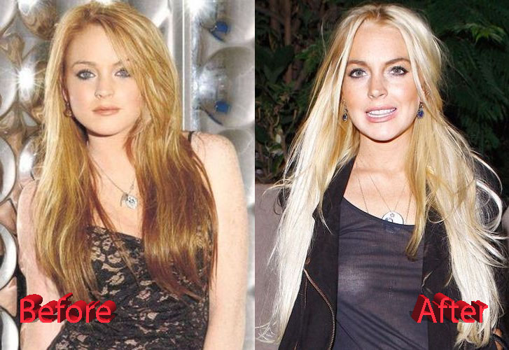 Lindsay Lohan Before and After Surgery Procedure