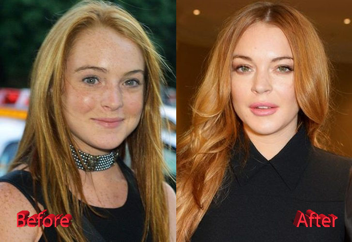 Lindsay Lohan Plastic Surgery Before and After