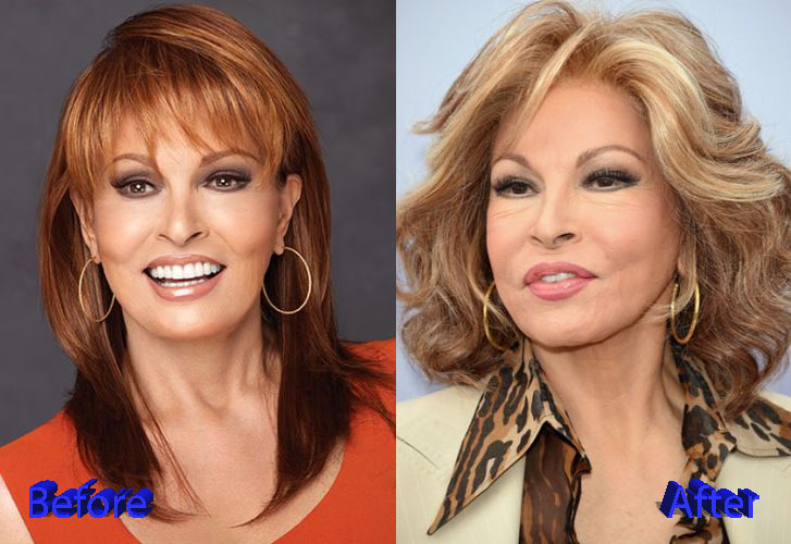 Raquel Welch Plastic Surgery Before and After
