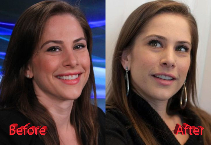 Ana Kasparian Before and After Nose Job Surgery.