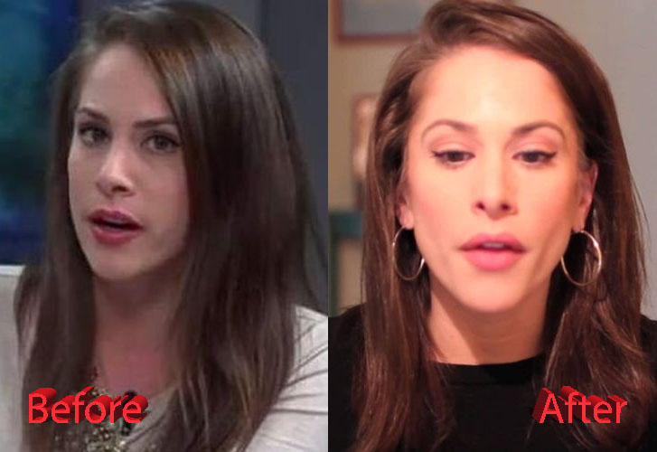 Ana Kasparian Before and After Nose Job