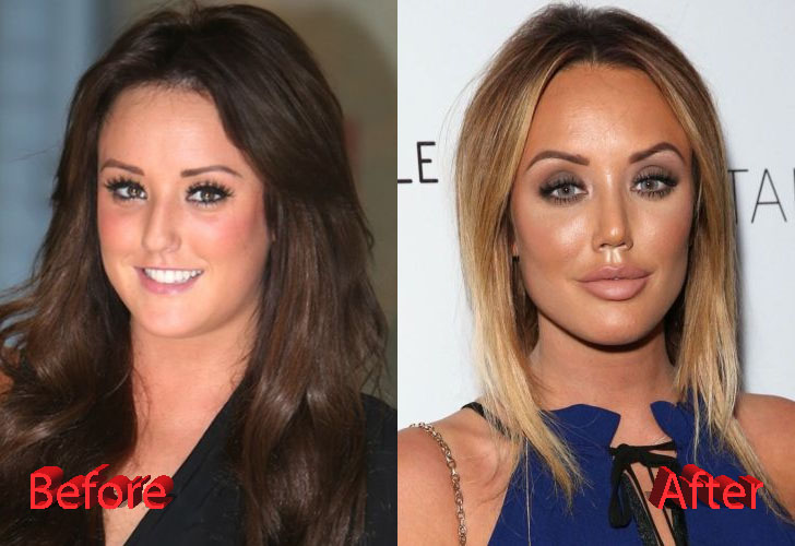 Charlotte Crosby Before and After Nose Job Surgery
