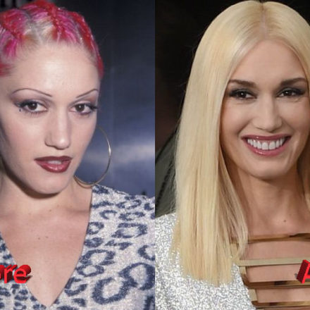 Gwen Stefani Plastic Surgery Then And Now