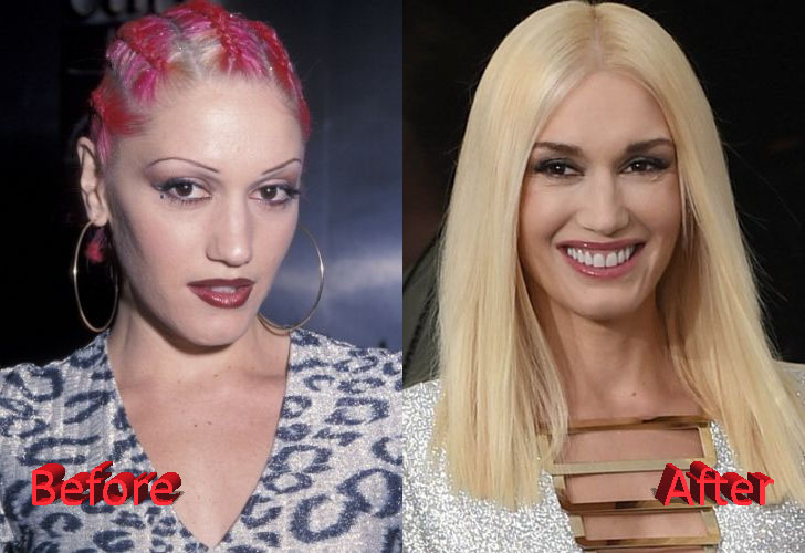Gwen Stefani Before and After Cosmetic Surgery