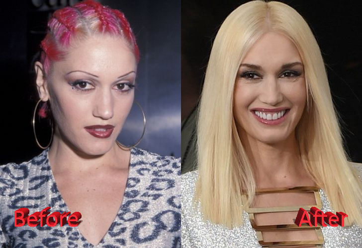 Gwen Stefani Plastic Surgery Then and Now