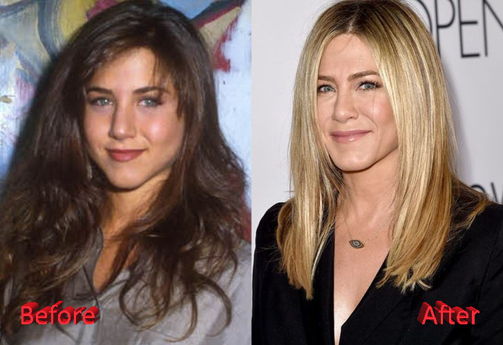 Jennifer Aniston Before and After NoseJob Surgery.