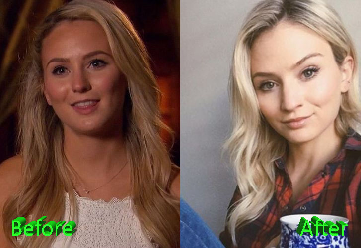 Lauren Bushnell Before and After Cosmetic Surgery