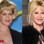 Melanie Griffith Before and After Cosmetic Surgery