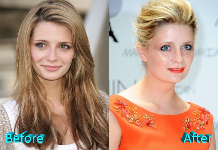Mischa Barton Before and After Cosmetic Surgery