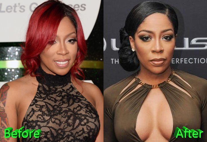 K Michelle Before and After Cosmetic Surgery