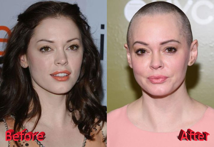 Rose McGowan Before and After Cosmetic Procedure