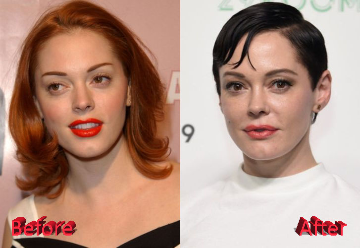 Rose Mcgowan Before And After Cosmetic Surgery 