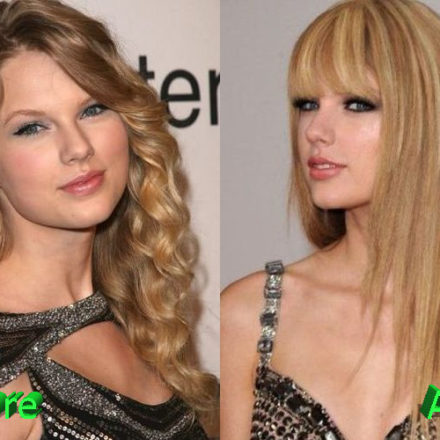 Taylor Swift Plastic Surgery Before and After