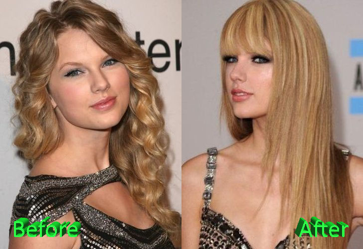 Taylor Swift Before and After Cosmetic Surgery