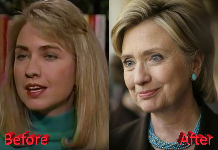 hillary-clinton-before-and-after-cosmetic-procedure