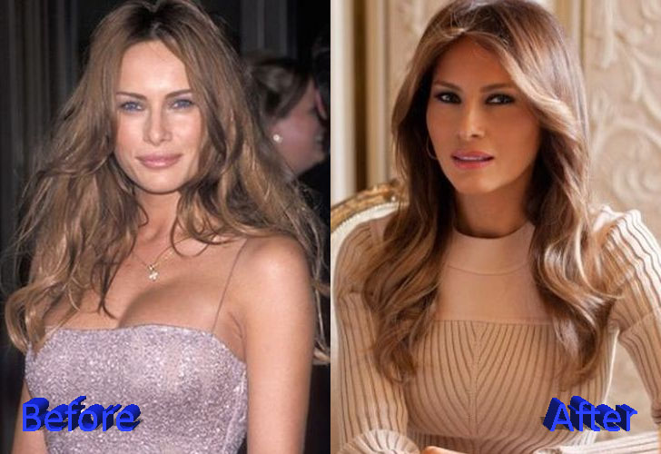 Melania Trump Before and After Cosmetic Surgery