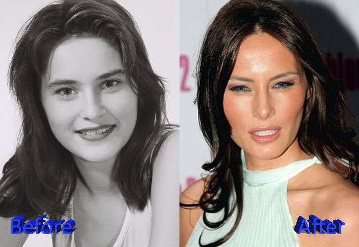 Melania Trump Before and After Surgery Procedure