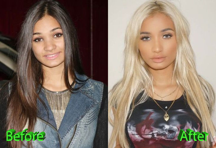 Pia Mia Before and After Cosmetic Surgery