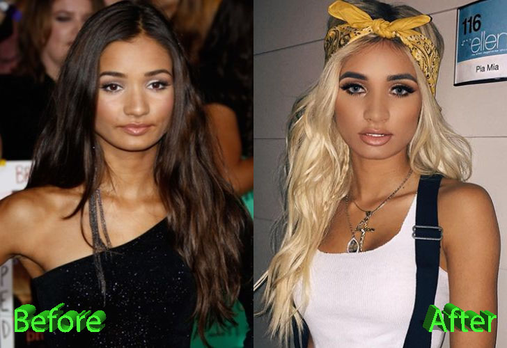 Pia Mia Before and After Surgery Procedure