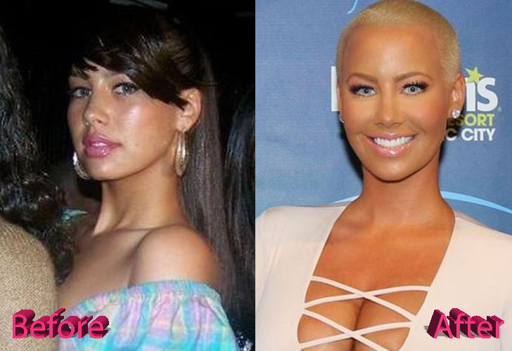Amber Rose Before and After Surgery Procedure