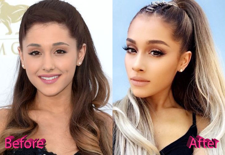 Ariana Grande Before and After Cosmetic Surgery