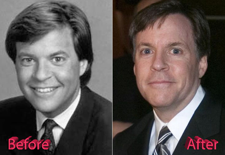 Bob Costas Before and After Cosmetic Surgery