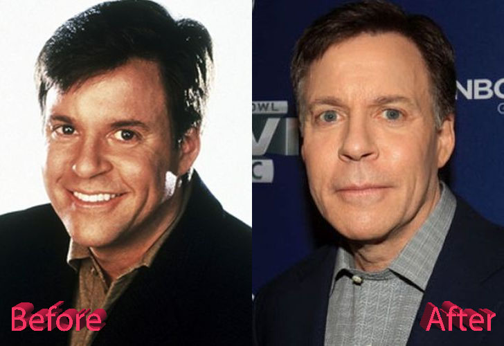 Bob Costas Before and After Surgery Procedure.