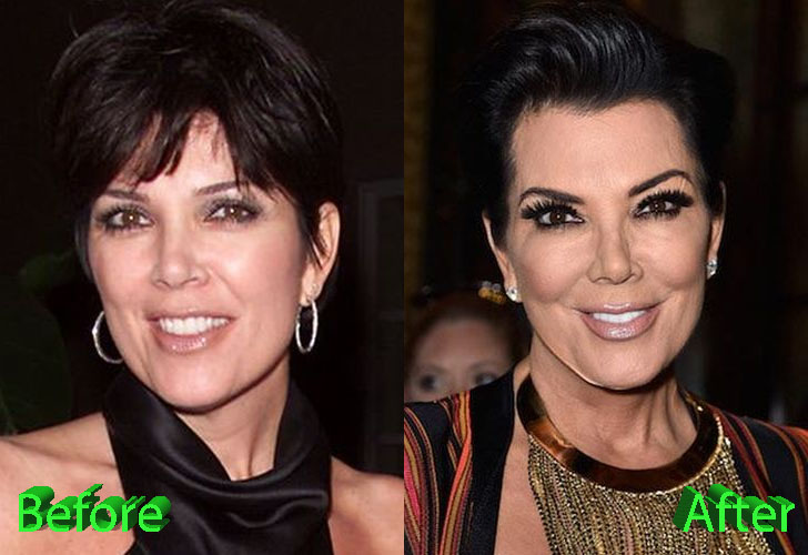 Kris Jenner Plastic Surgery A Really Beautiful Granny   Kris Jenner Before And After Facelift Procedure 