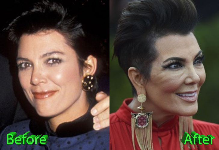 kris-jenner-plastic-surgery-before-and-after