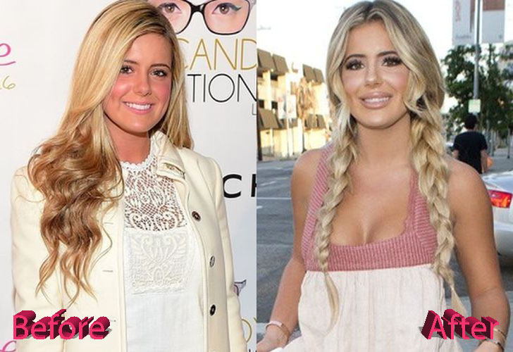 Brielle Biermann Before and After Surgery Procedure