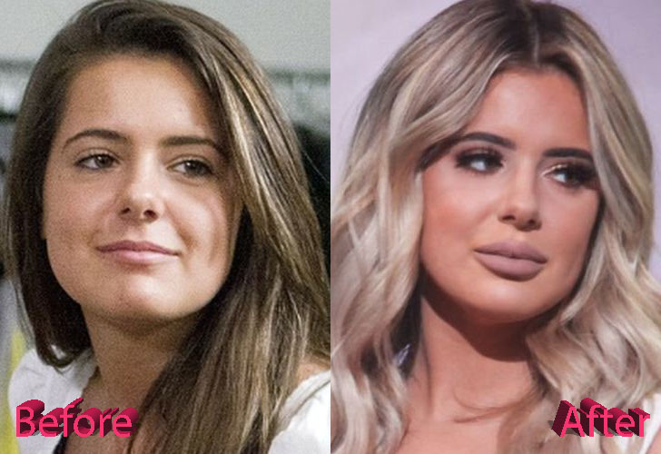 Brielle Biermann Plastic Surgery Before and After