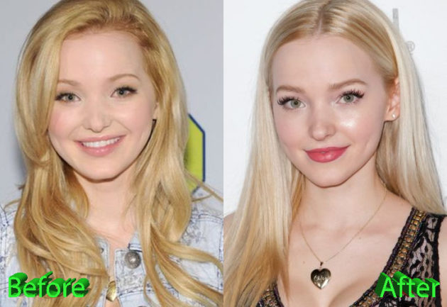 Dove Cameron Plastic Surgery: A Few Suspicious Changes