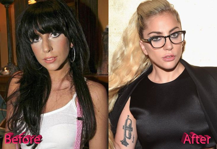 Lady Gaga Before and After Cosmetic Surgery