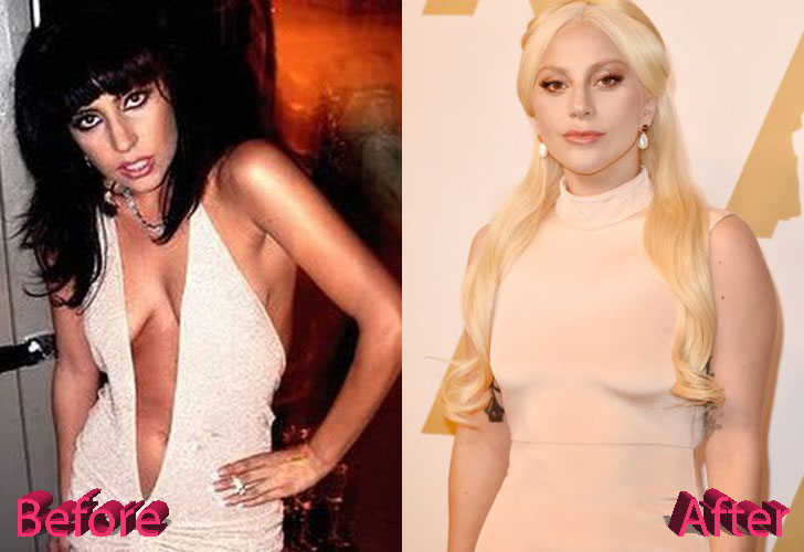 Lady Gaga Before and After Surgery Procedure