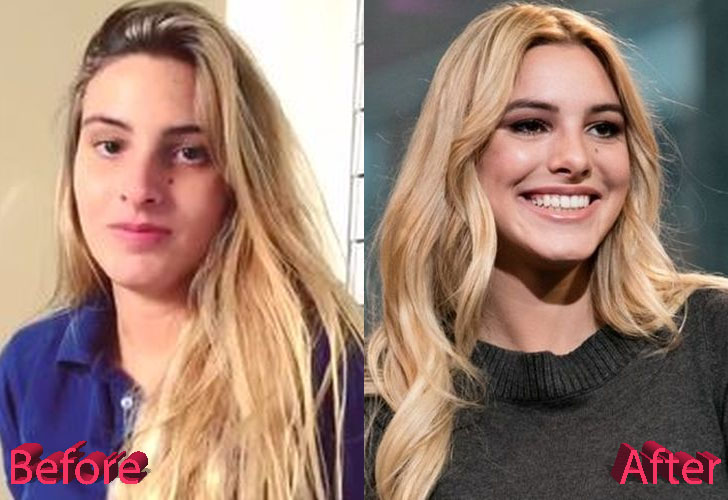 Lele Pons Before and After Rhinoplasty Surgery.