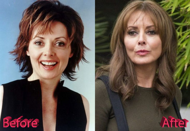 Carol Vorderman Plastic Surgery Still Looking Great