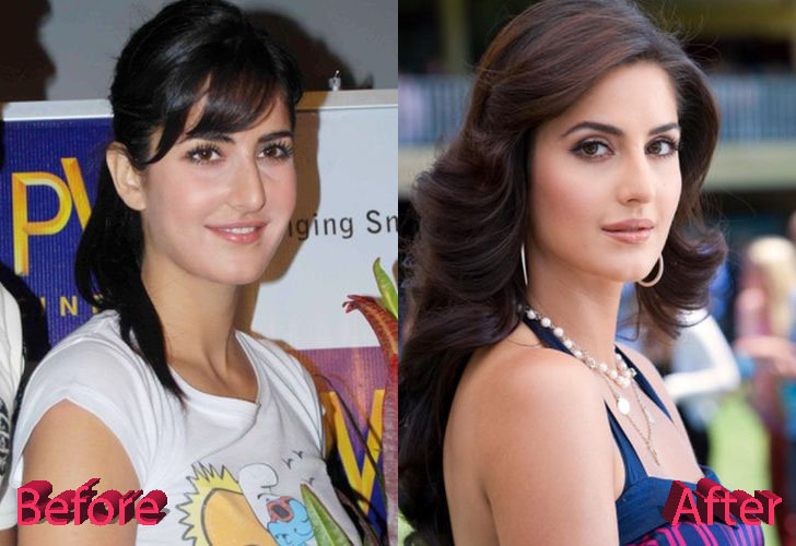 Katrina Kaif Before and After Cosmetic Surgery