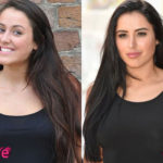 Marnie Simpson Before and After Rhinoplasty Surgery