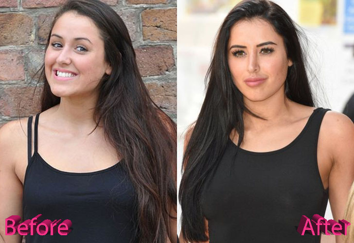 Marnie Simpson Before and After Rhinoplasty Surgery