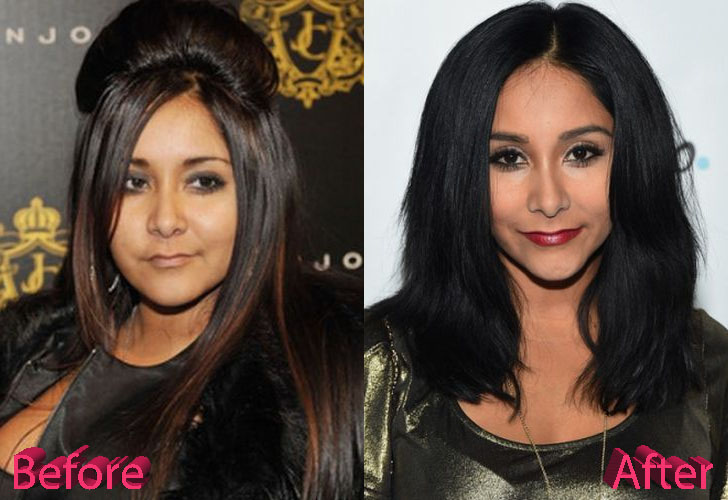 Snooki Before and After Surgery Procedure