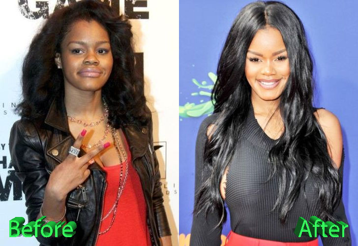 Teyana Taylor Before and After Surgery Procedure