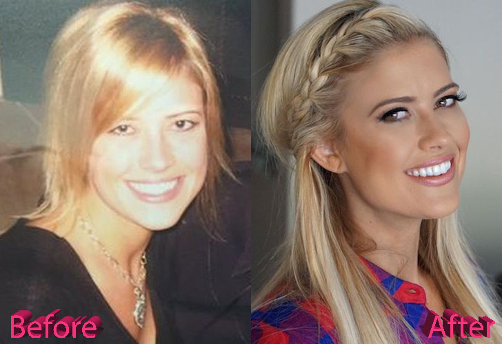 Christina El Moussa Before and After Cosmetic Surgery