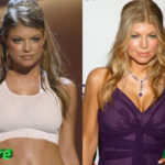 Fergie Before and After Surgery Procedure