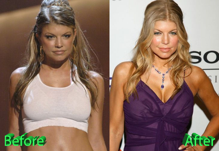 Fergie Before and After Surgery Procedure