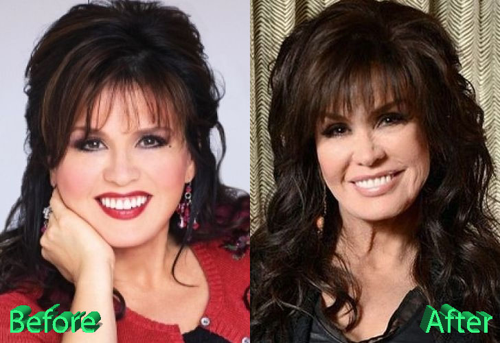 Marie Osmond Plastic Surgery Marie S Youthful Looks